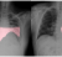 covid-net covid-19 lungs via darwinAI